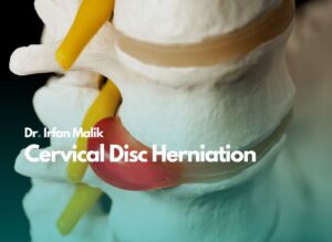 Cervical Disc Herniation